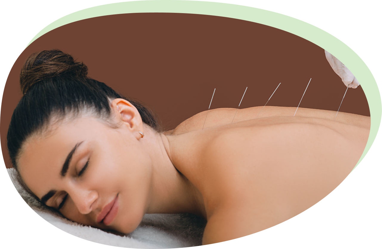 Acupuncture